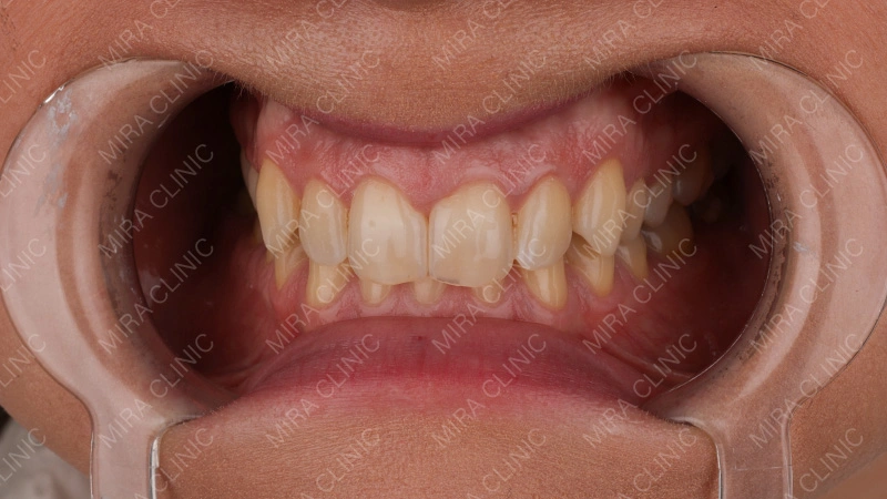 Veneers before after in turkey